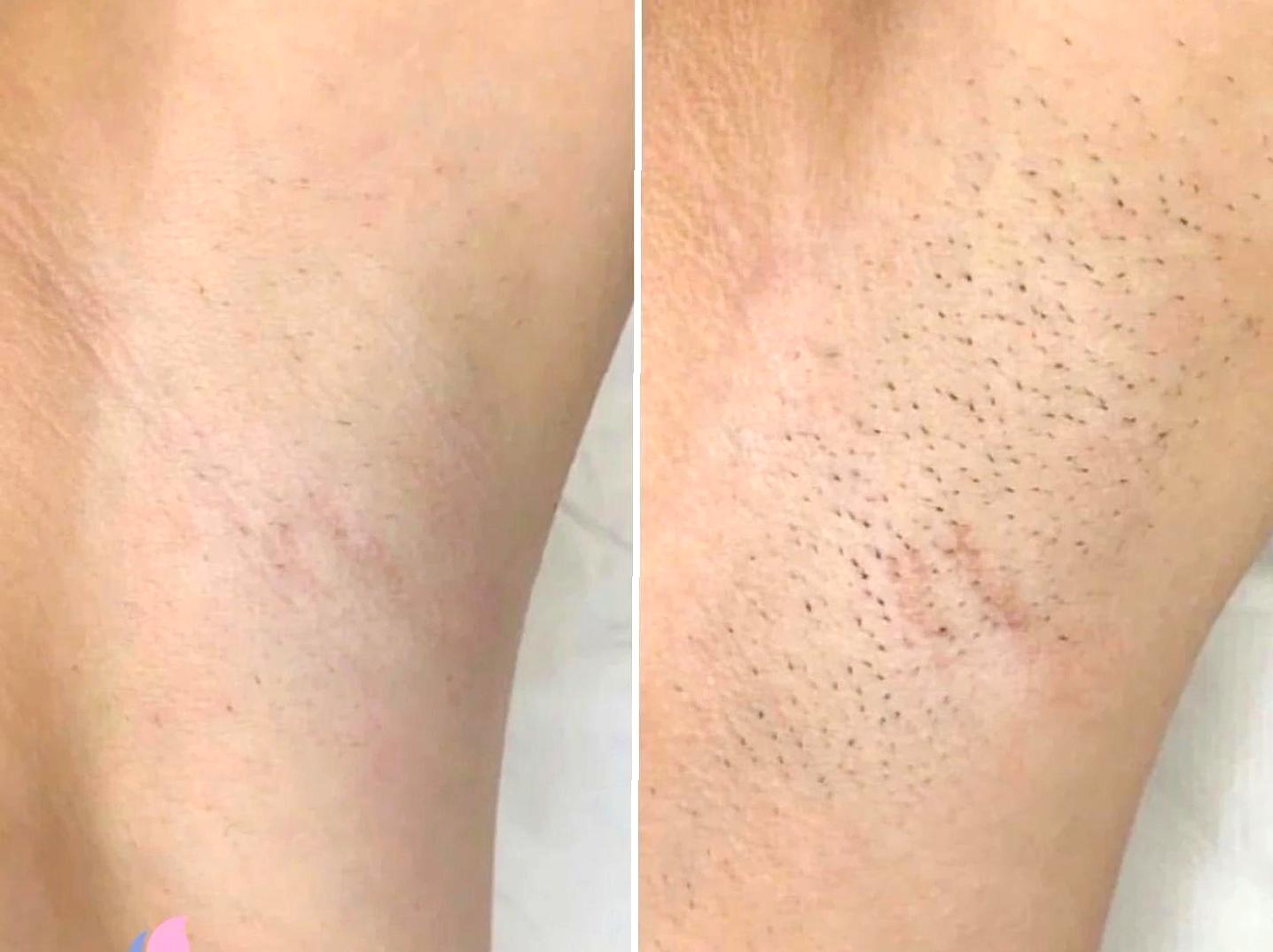 Strategies and Success Rates in Permanent Hair Removal