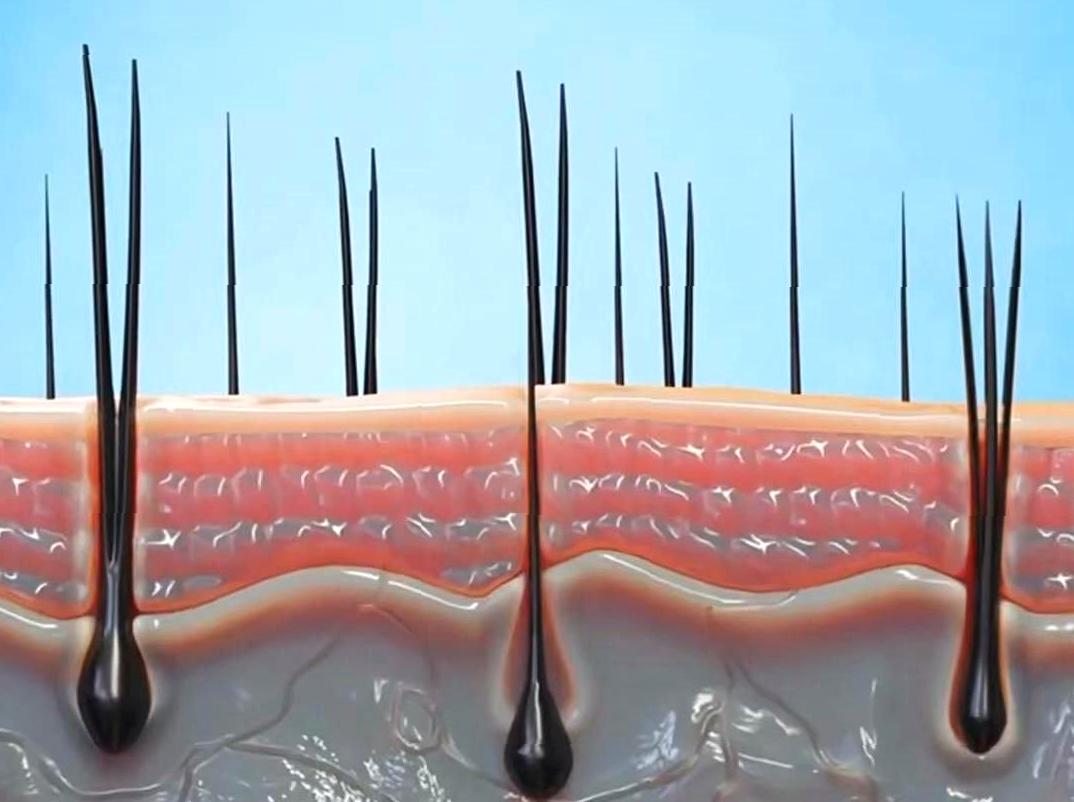 Methods and Impact of Persistent Hair Removal