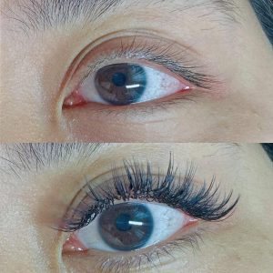 before and after dark lip neutralisation