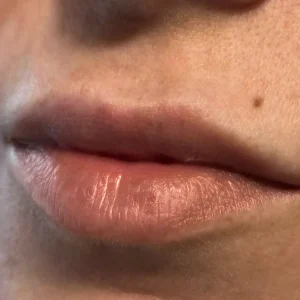 before and after lip neutralisation melanin rich