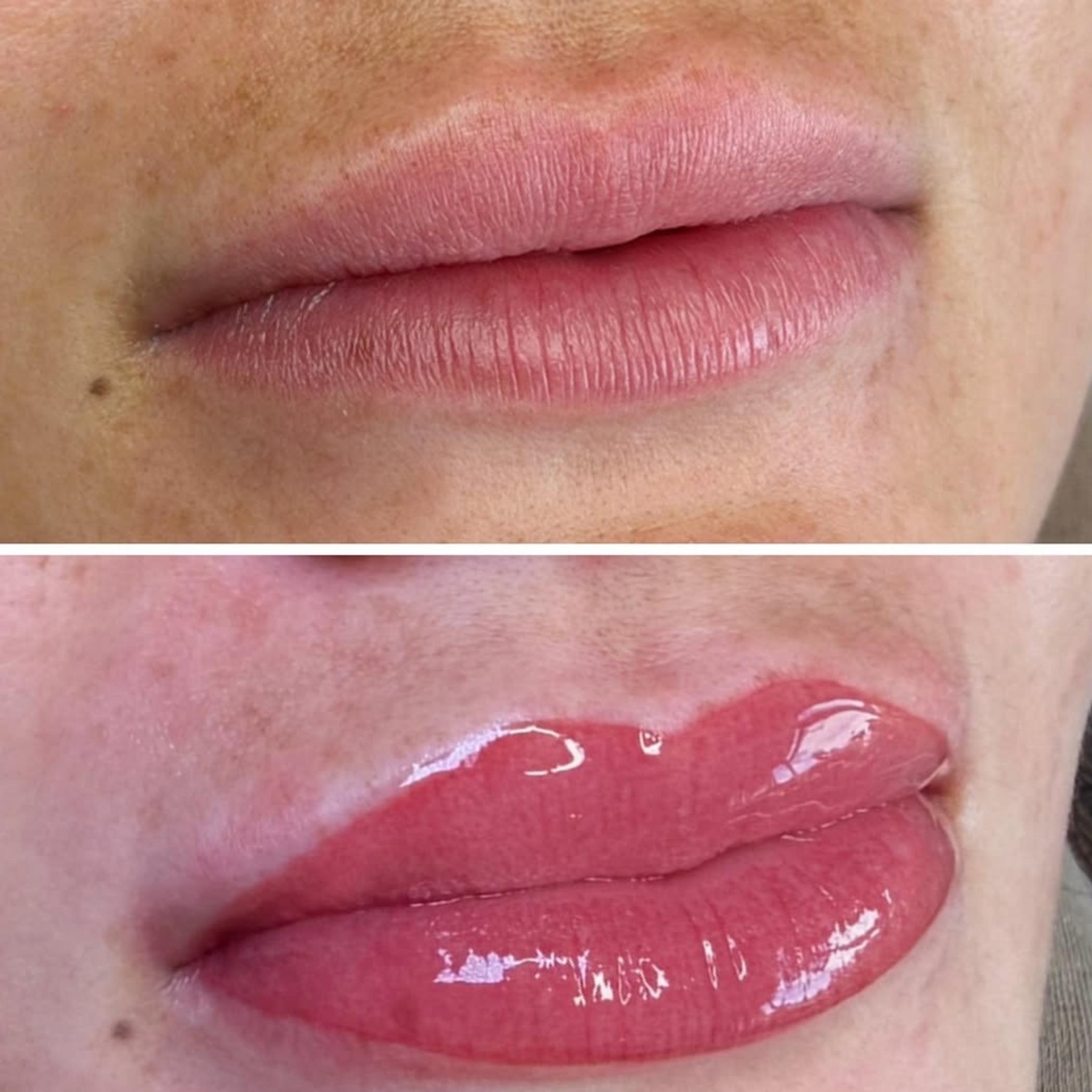 lip contouring process step by step