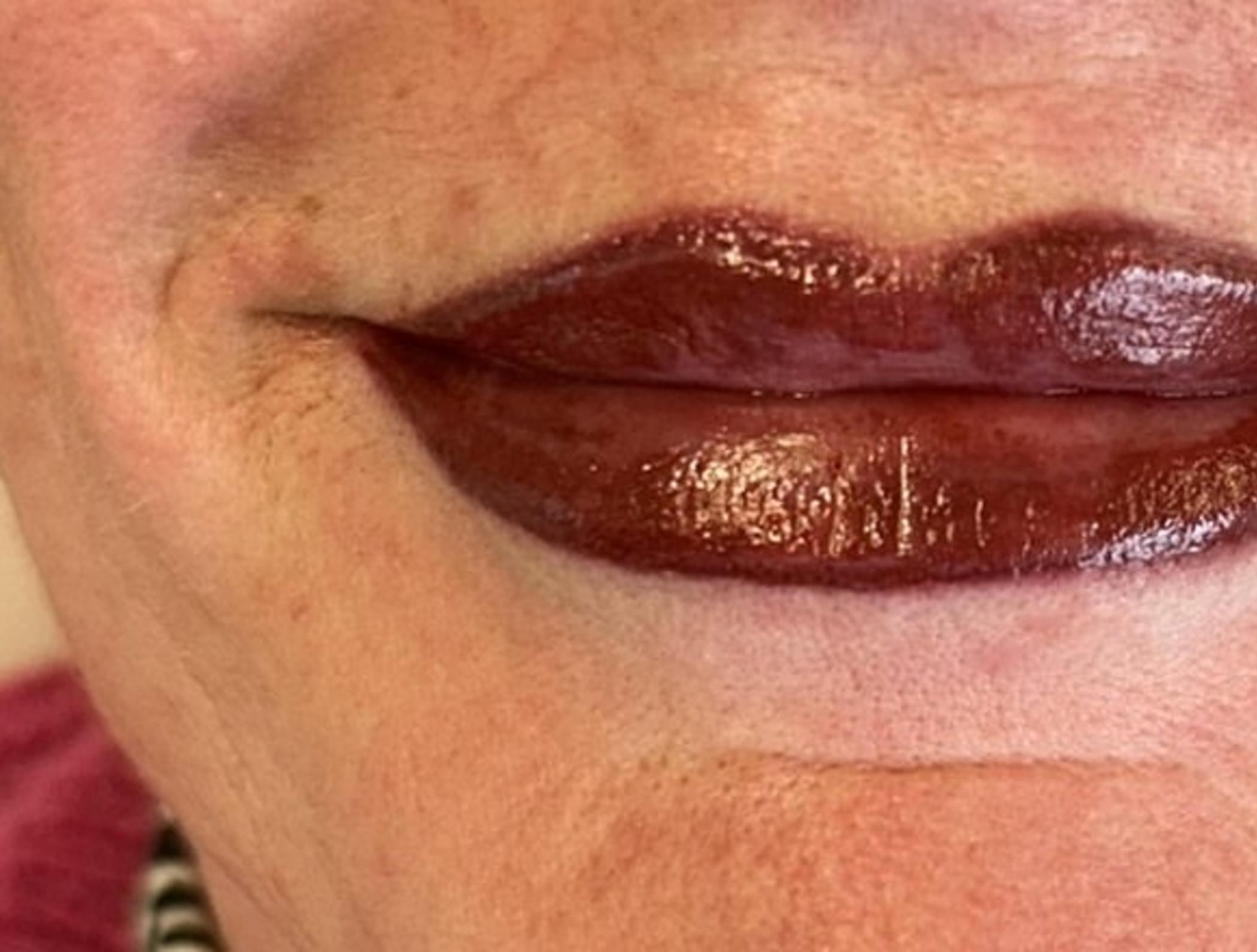 lip correction procedure session