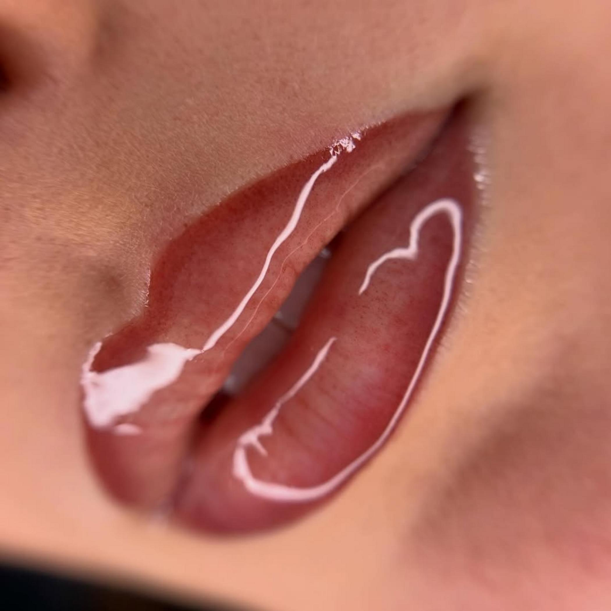 lip neutralisation procedure step by step