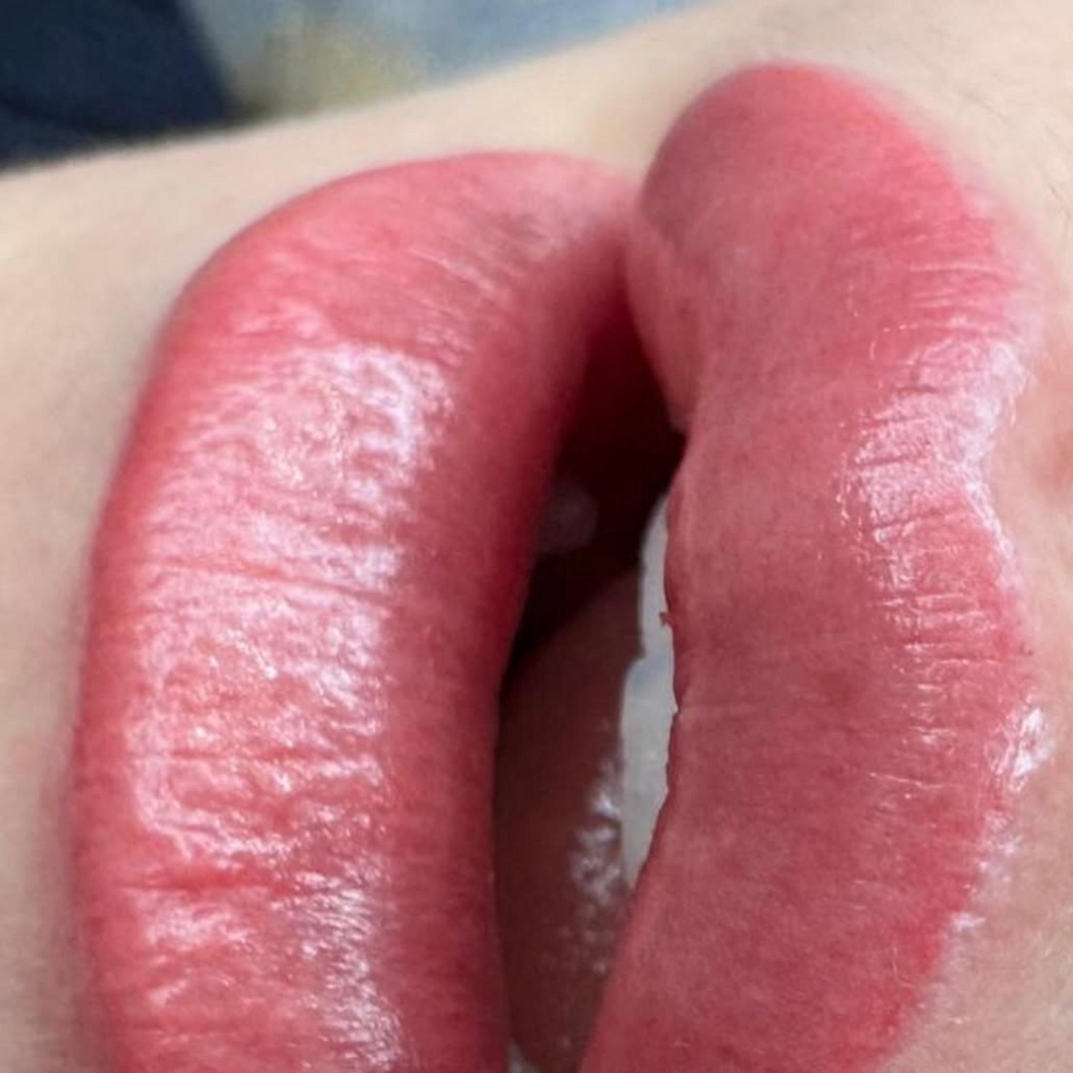 technician shaping lip outline